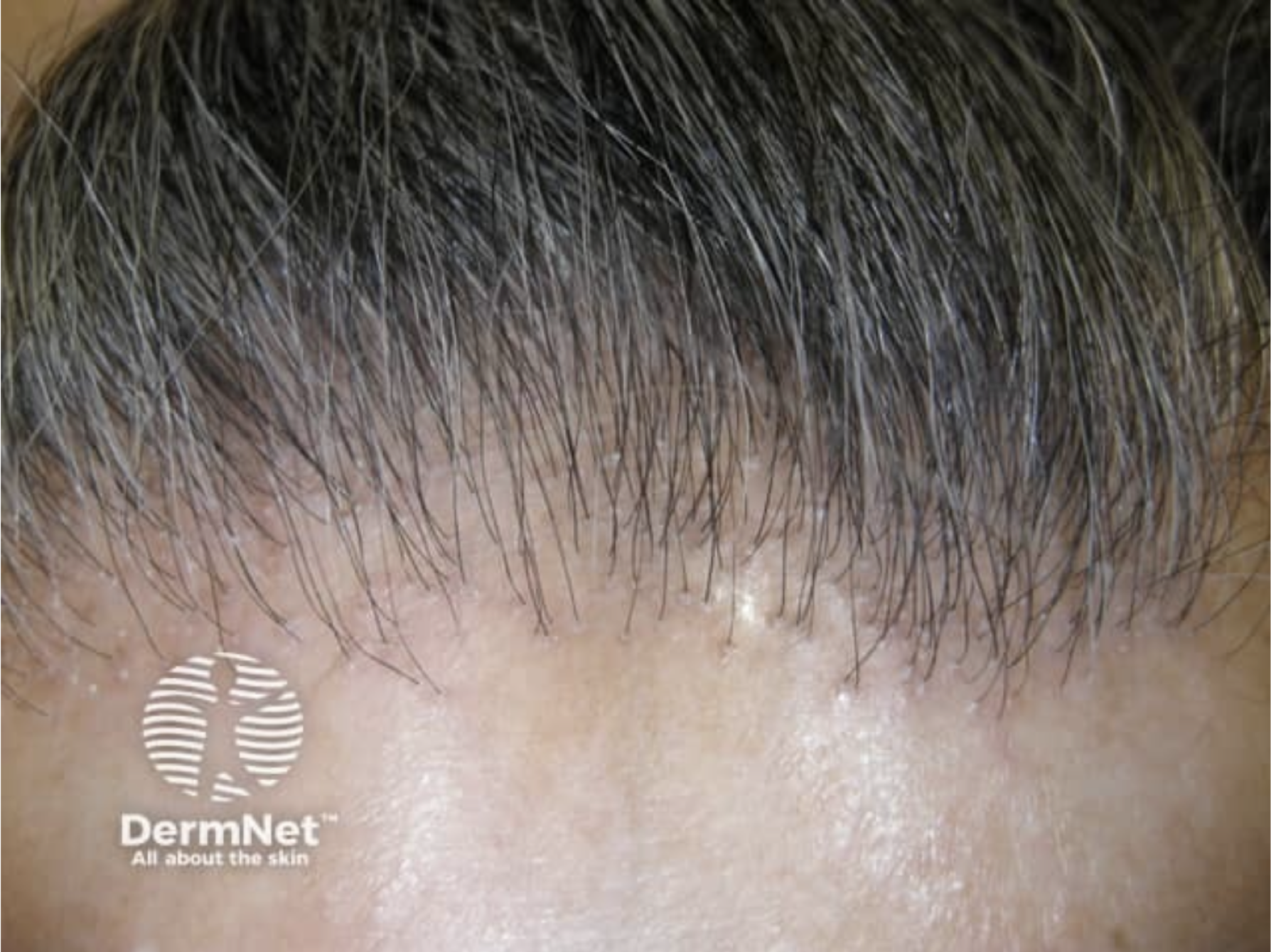 vernarbte Alopecia 1